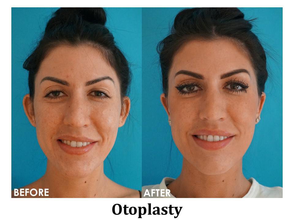 Non-Invasive Skin Tightening Services Available with Dr. Anthony